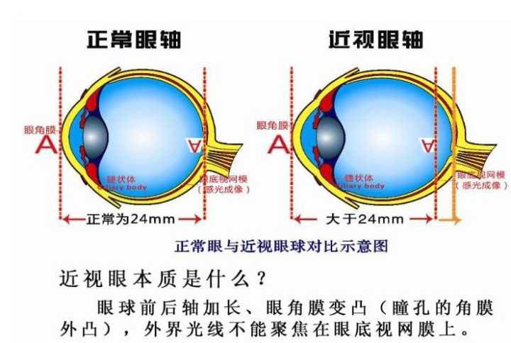 为什么会近视是什么原理