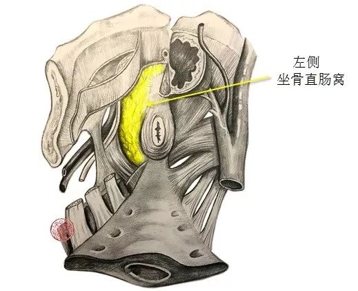 医学笔记|从腹腔侧观察坐骨直肠窝的局部解剖