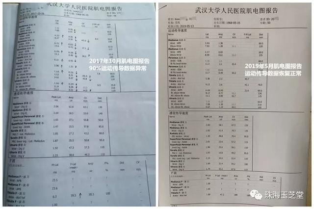 2019年中国渐冻人症als专家张清海"渐冻人症"成功案例