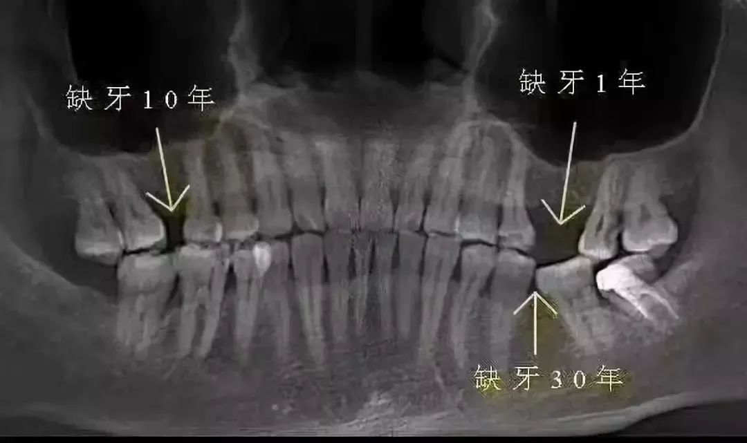 种牙最好的季节是哪个 534c75a64f614282b58a3101f734bb40.jpeg