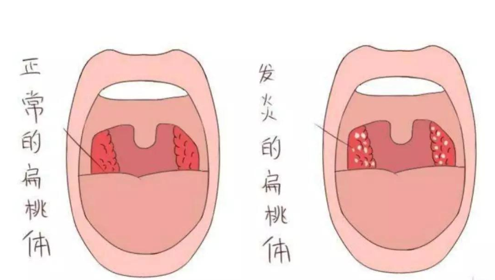 扁桃体总爱发炎,怎样才能远离?做好预防主要看这几点!