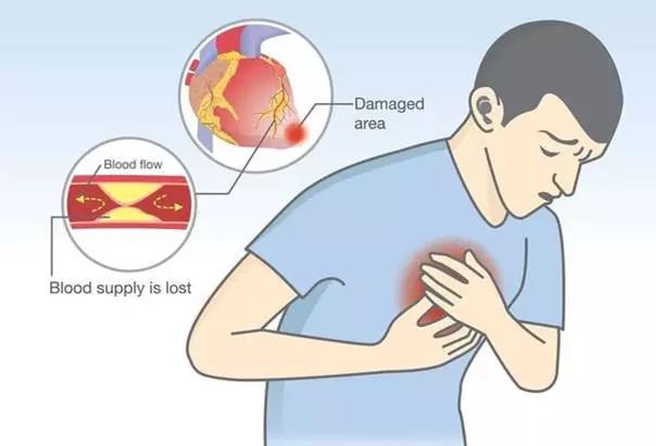牢记心梗发作时四要四不要