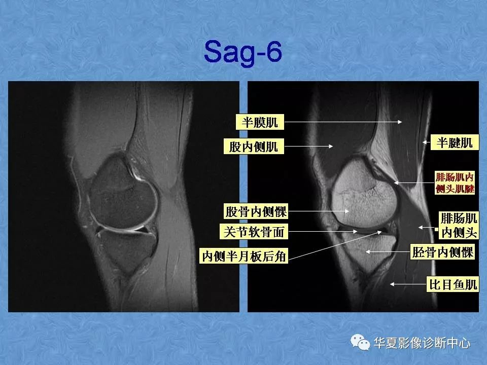 膝关节高清mri解剖