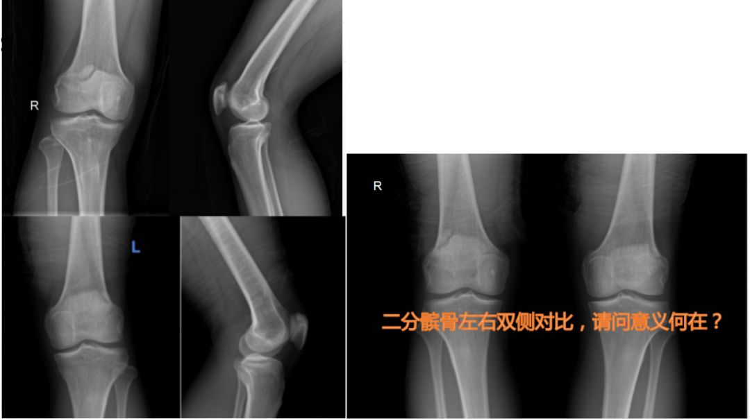 【看片技巧干货】骨折还是二分骨?这些看片技巧不可错过!_髌骨