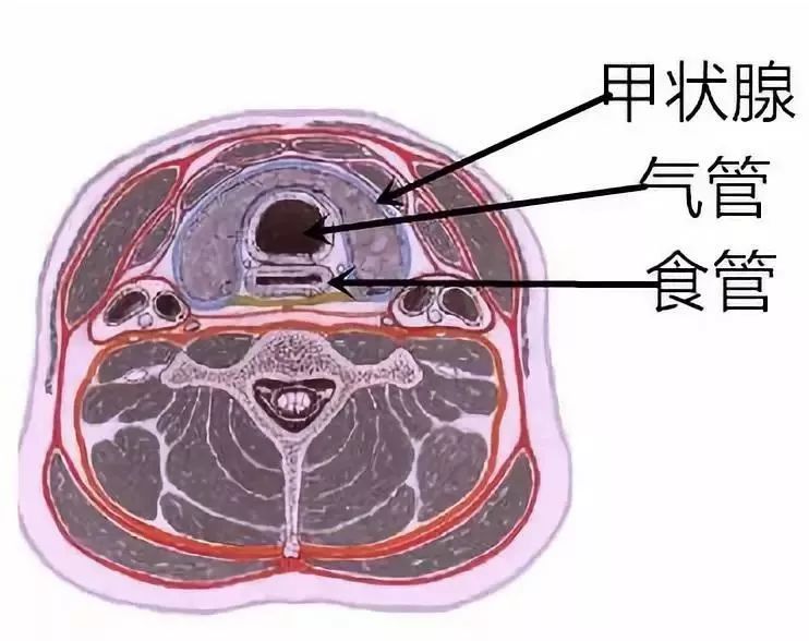 颈段食道癌:可能会被忽视或误诊的甲状腺后方肿块