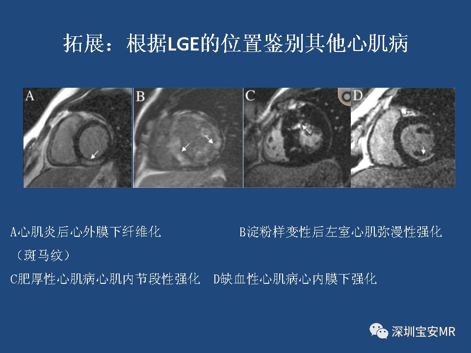 影像病例学习:致心律失常性右室心肌病