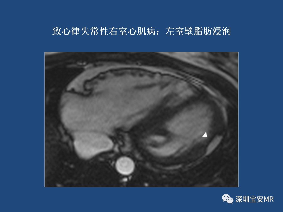 影像病例学习:致心律失常性右室心肌病