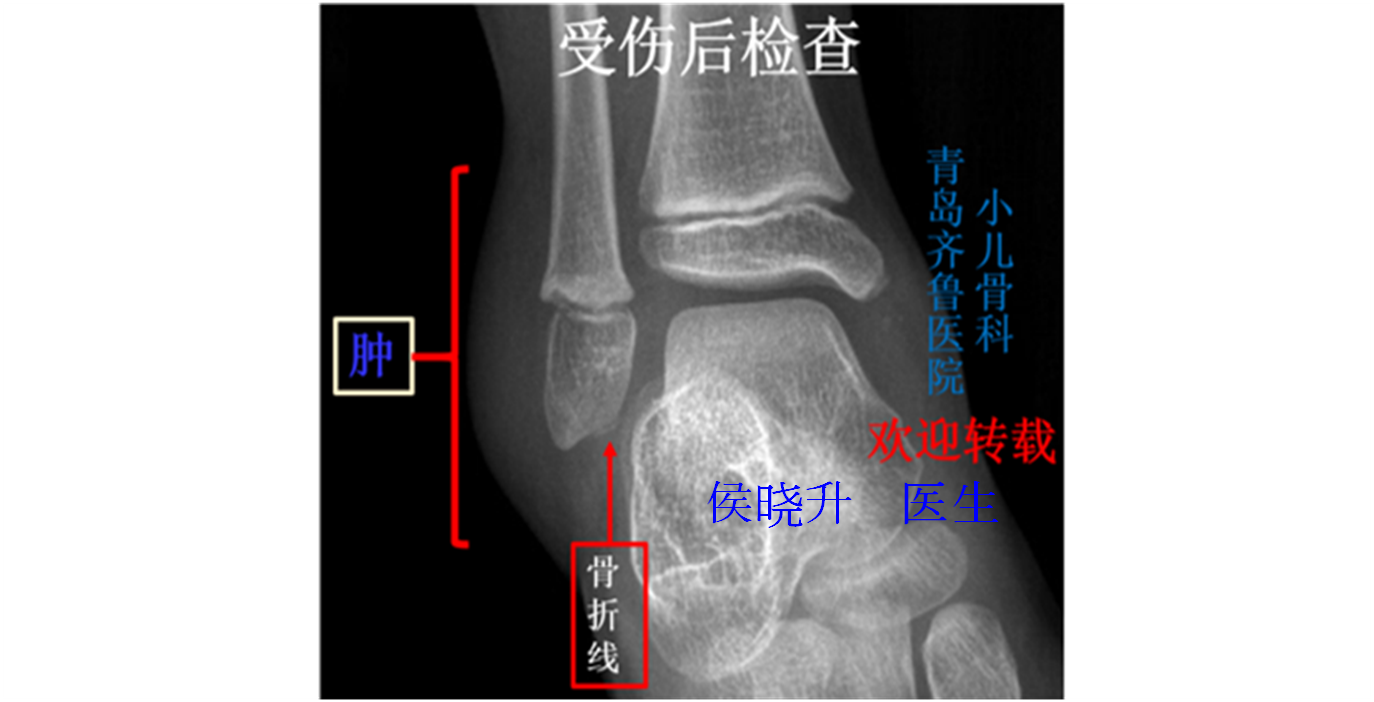 【齐鲁医院青岛院区儿童骨科专家】孩子脚扭伤了,当心是骨折,看小儿