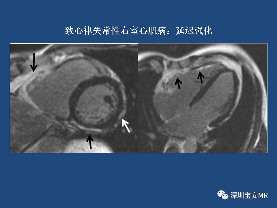 影像病例学习:致心律失常性右室心肌病