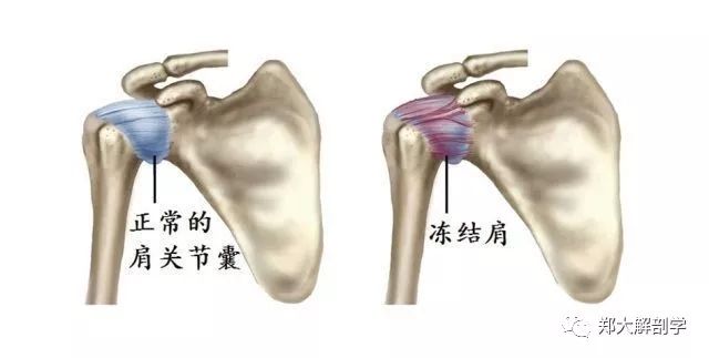 肩关节的疼痛综合征_关节炎