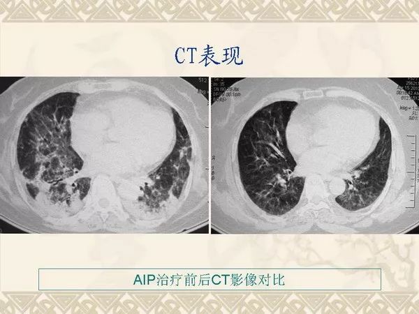 急性间质性肺炎的诊断与鉴别诊断