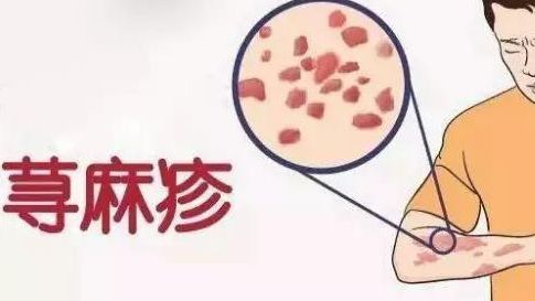 一到冬天就浑身痒?9种皮肤病解决方案送给你