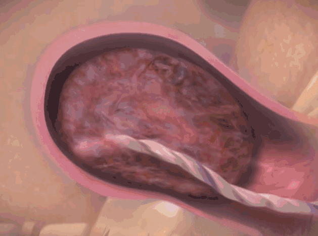 踩在道德红线上去愚昧健康:9102年还有人吃胎盘