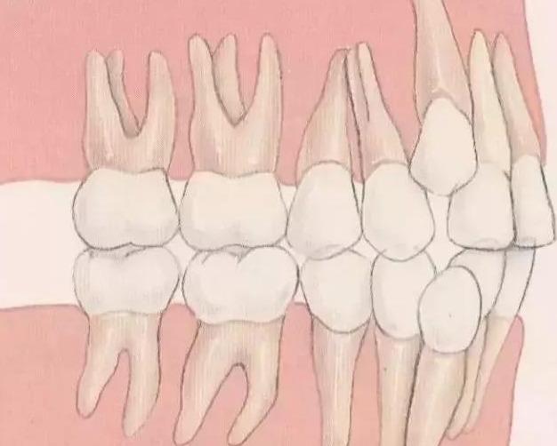 科普|10种常见儿童牙颌畸形