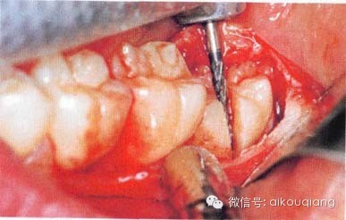 口腔麻醉拔牙术阻生牙拔除