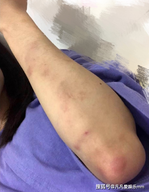 女团成员被同团女生打伤?伤痕累累触目惊心,依然称对方是好朋友
