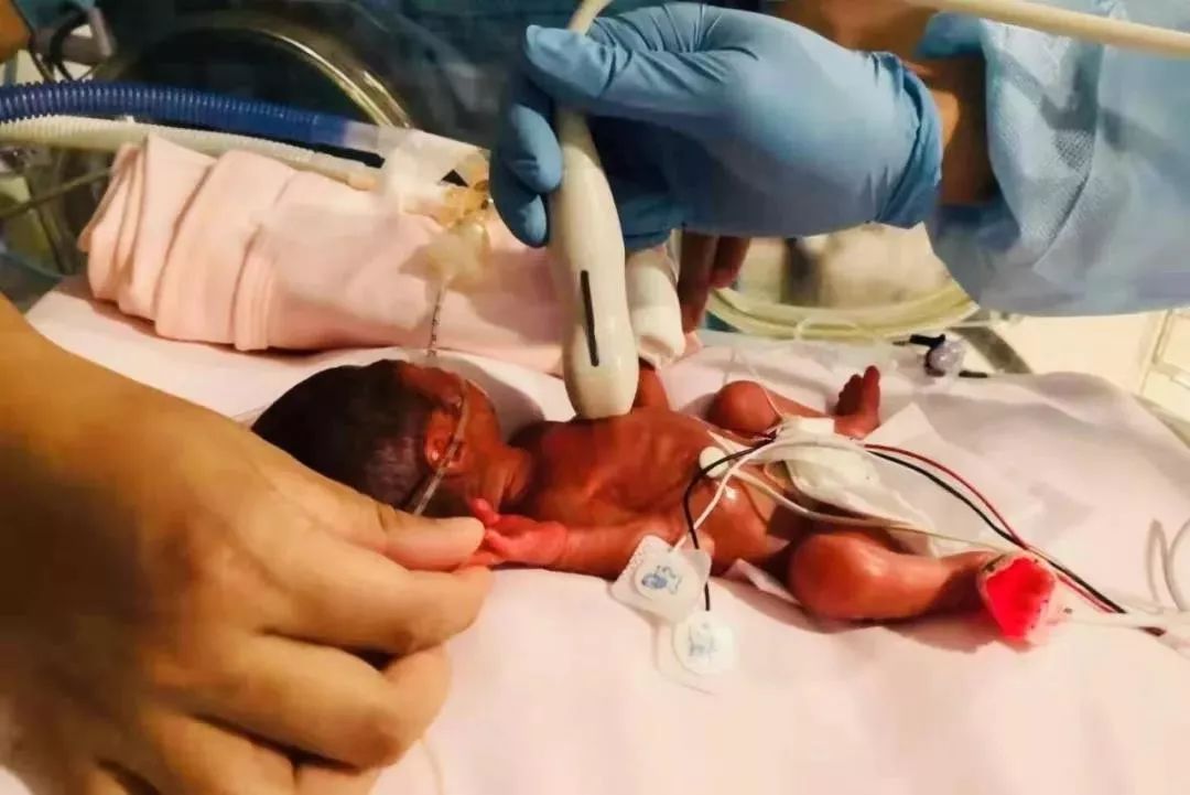 父母世界Parents@NICU里的奇迹｜590克！这个超早产儿只有手掌大小、一瓶矿泉水重