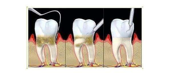 做龈下刮治很痛?其实不一定