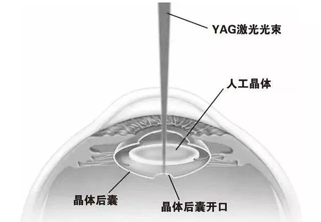 网络图 yag激光后囊膜切开术示意图 说到这,您差不多能明白"白内障