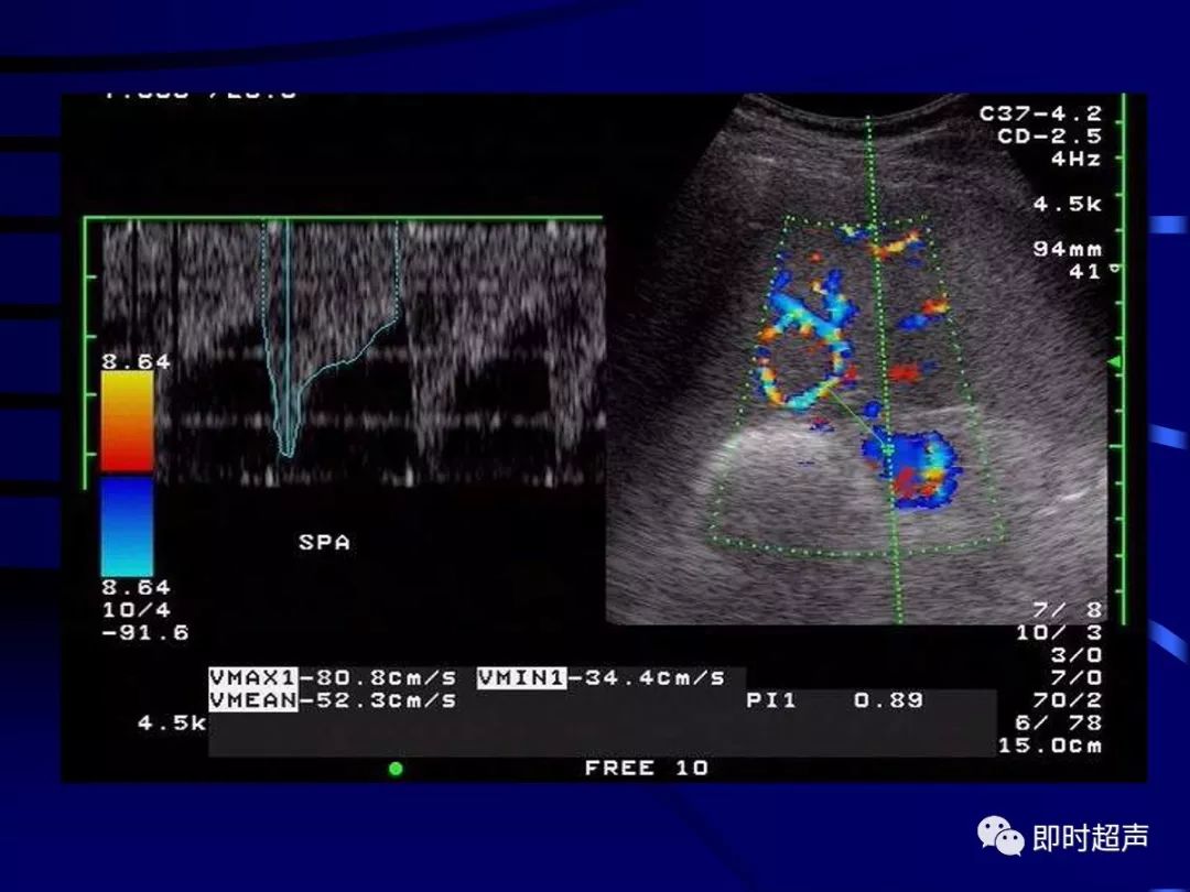 周围血管疾病多普勒超声检查_血流