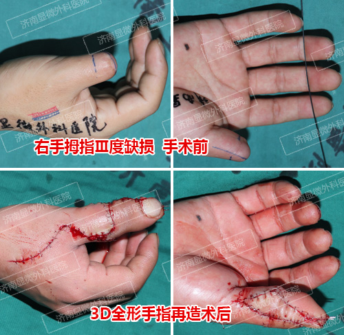 3d全形手指再造康复案例:右手拇指Ⅲ度缺损