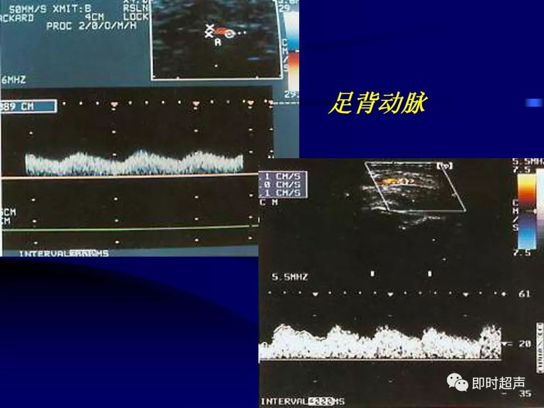 周围血管疾病多普勒超声检查