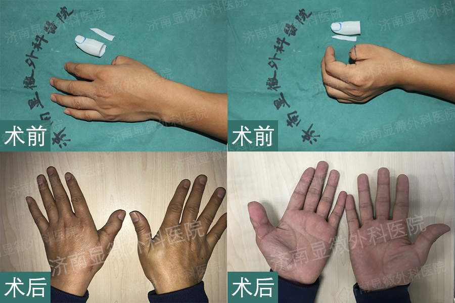 3d全形手指再造康复案例:左手拇指Ⅲ度缺损