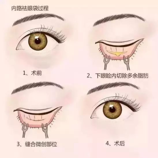 怎么才能去眼袋的皱纹 577051fa5f1e4e4fae419fb1ce0bb27a.jpeg