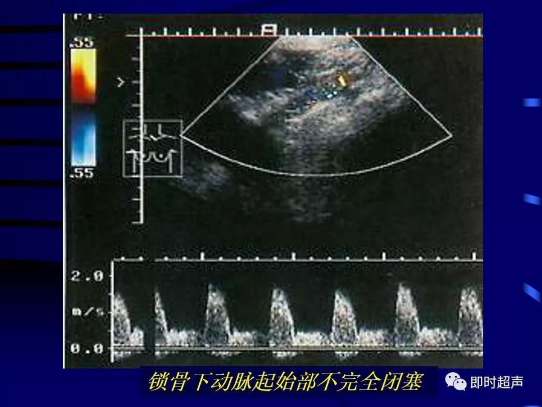 周围血管疾病多普勒超声检查