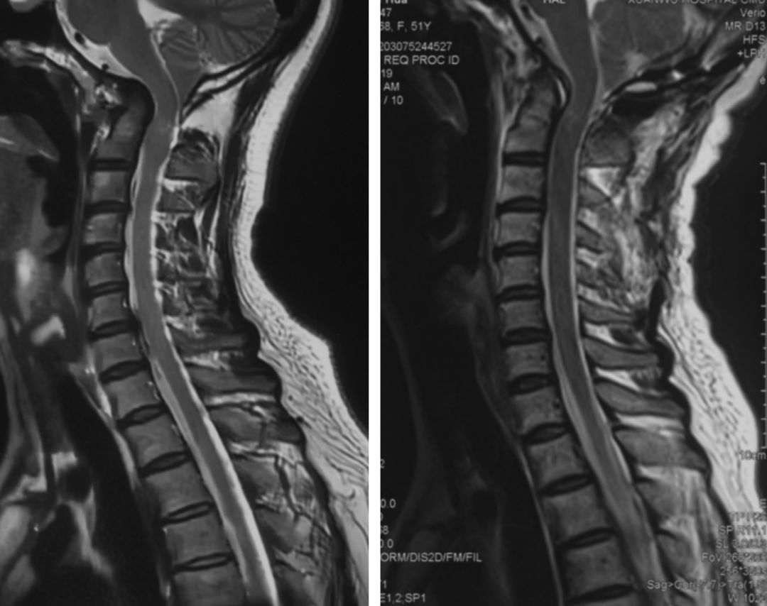 病例二(陈赞教授手术病例1)图2:患者颈椎核磁矢状位t2像术前术后对比