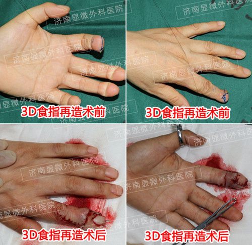 3d全形手指再造康复案例:左手食指Ⅰ度缺损