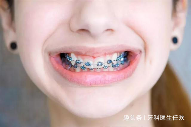 儿童牙齿矫正的黄金时期,家长们不要错过了!