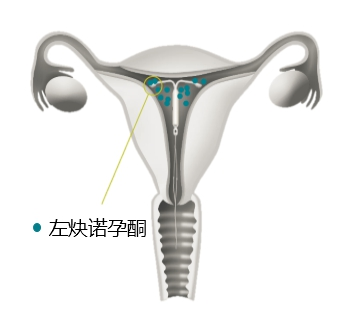 带节育环不怀孕是什么原理_节育环带在什么位置(2)