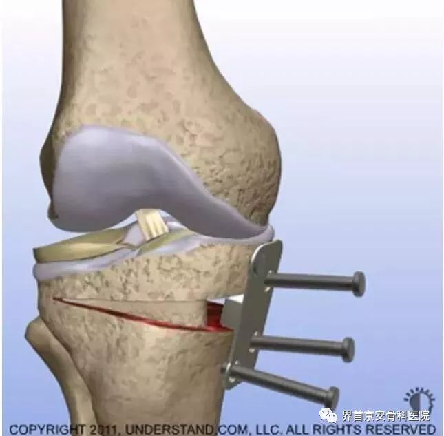 界首京安丨胫骨截骨术——膝关节骨性关节炎的"保膝"治疗
