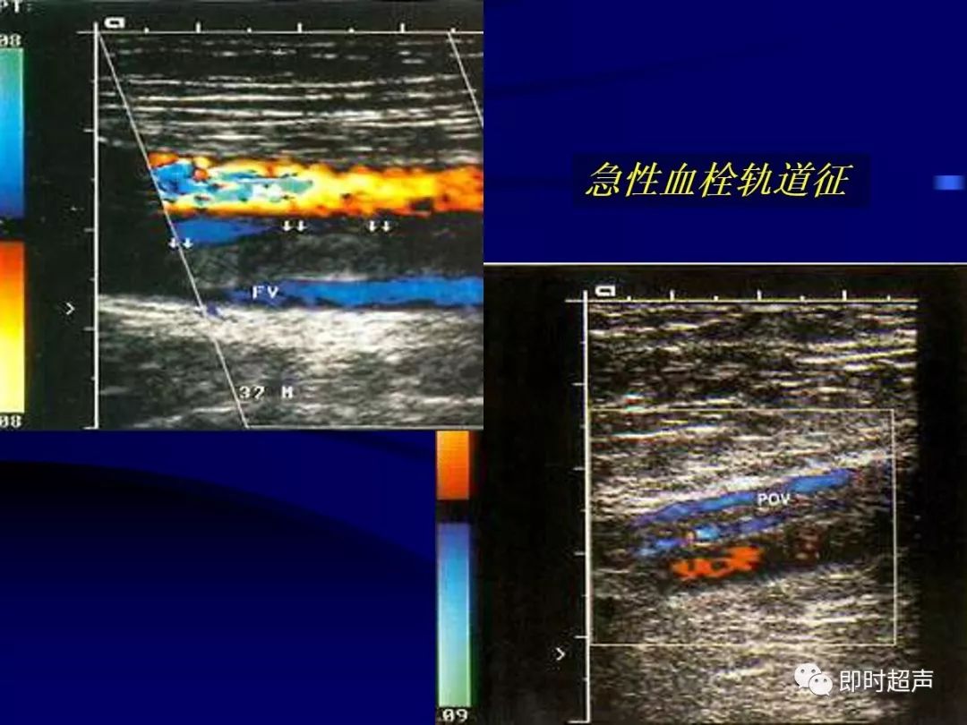 周围血管疾病多普勒超声检查