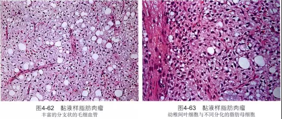 树突状纤维粘液样脂肪瘤