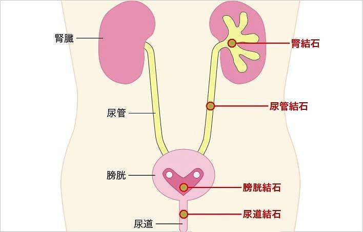 肾结石在输尿管怎么办