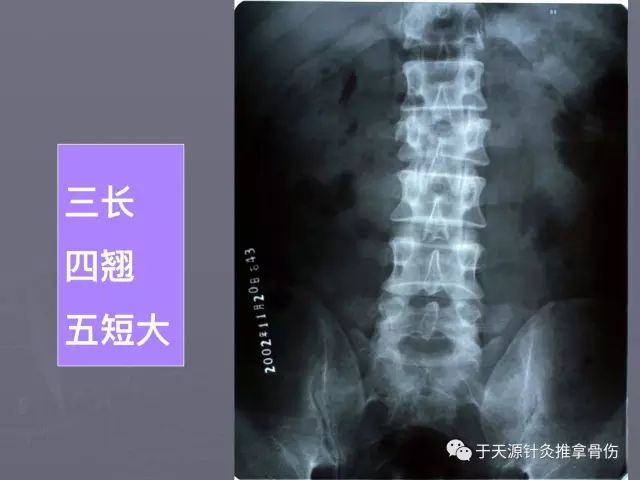 听故事学推拿085腰三横突综合征的治疗