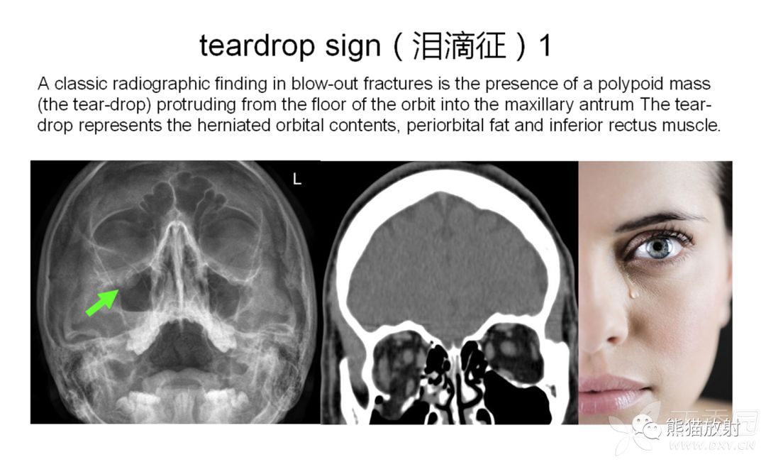 泪滴征:为一眼眶爆裂性骨折经典的放射学征象,眶内脂肪或下直肌呈