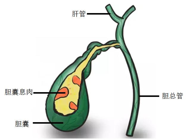 原创胆囊息肉你离胆囊癌有多远黄安华胆病科普系列