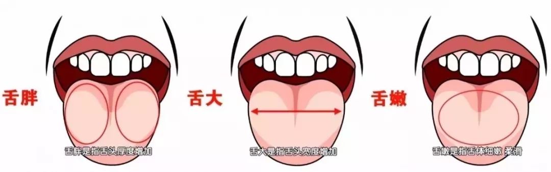3唇舌肥厚