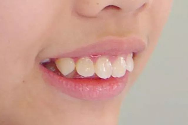 北大口腔周彦恒教授:7岁左右是第一个牙齿矫正黄金期