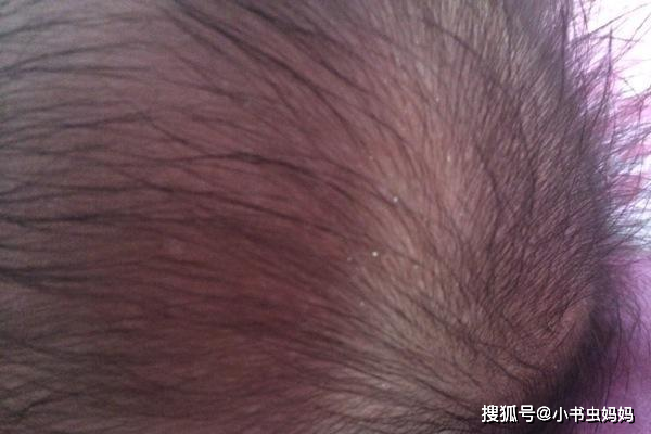 宝宝怎么睡出蓬松软头皮 e06a5e1e5c094a4bac7ae365af361886.png