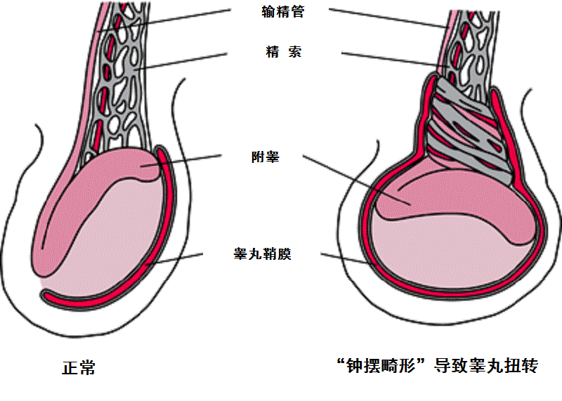 为什么孩子"蛋疼"的诊治一刻也耽误不得?_睾丸