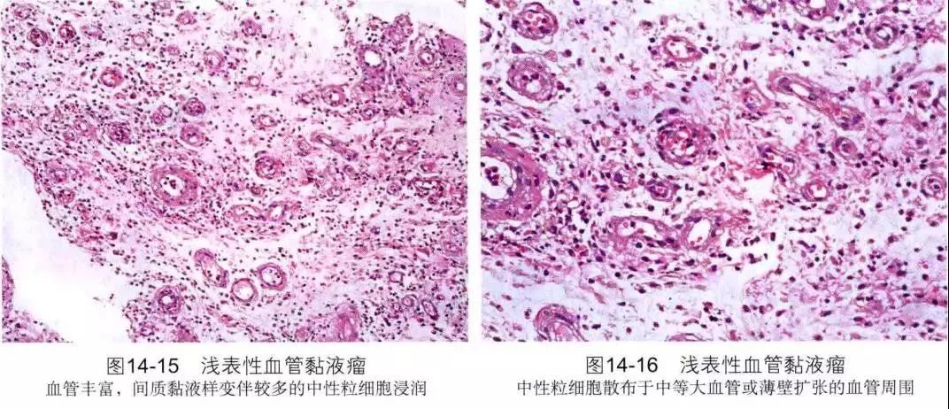 树突状纤维粘液样脂肪瘤