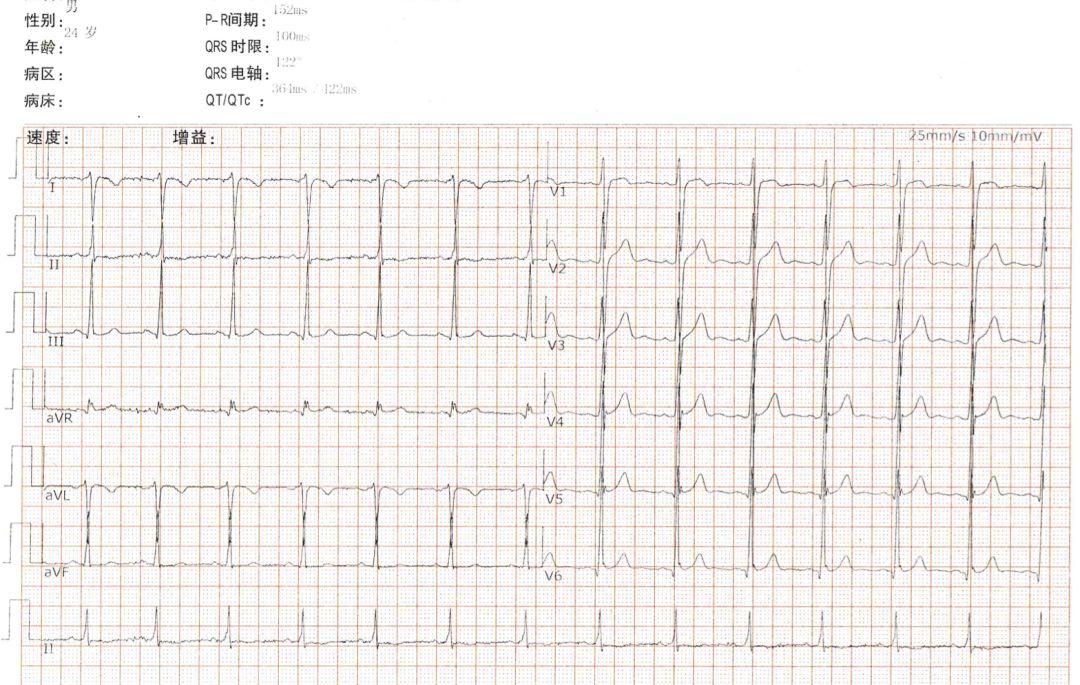 这张心电图总感觉不对劲!问题在哪儿?