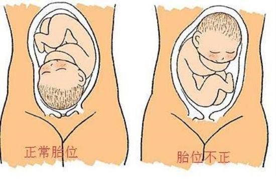 例如顶先露,枕骨在骨盆左侧,朝前,则胎位为左枕前(loa),为最常见的