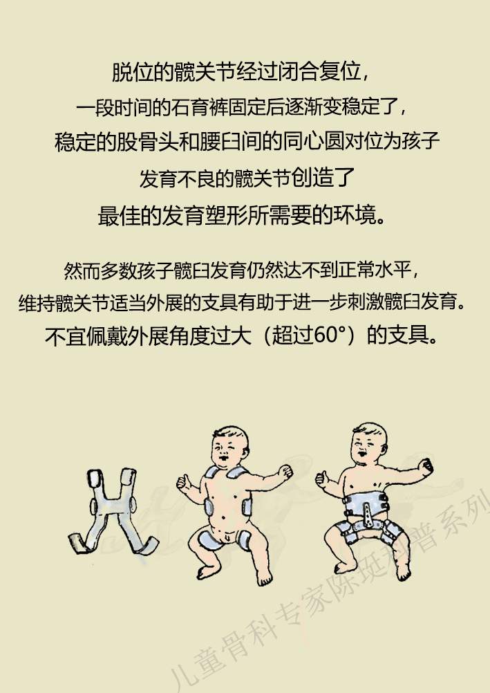 什么是小儿发育性髋关节脱位