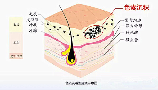 皮肤灼伤留下色素沉着怎么办