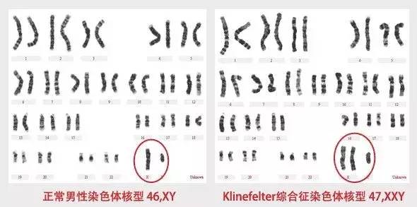 【科普】福音!佛山地区首例克氏综合征患者妻子成功怀孕